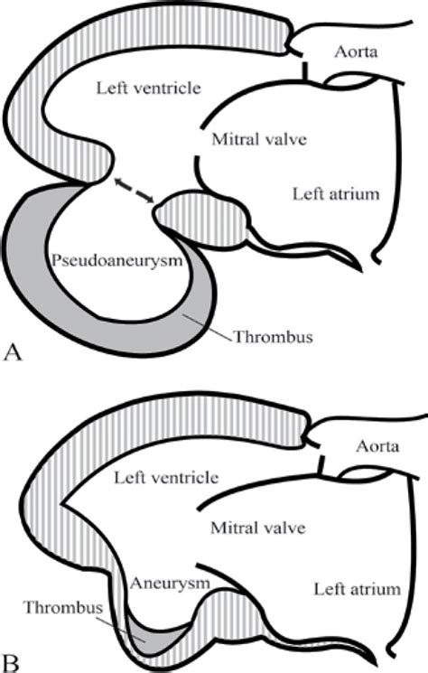 lv pseudoaneurysm vs true aneurysm radiology|lv aneurysm post mi.